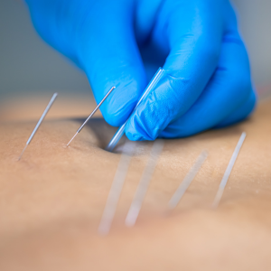 Serviço de Acupuntura SetCare